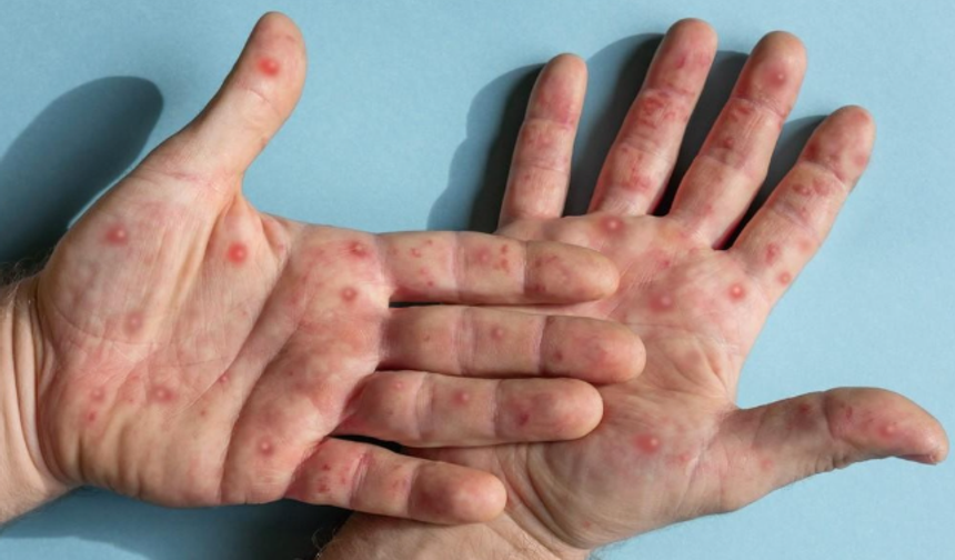 Ölümcül Mpox Varyantı Kapıda: Alanya Alarmda